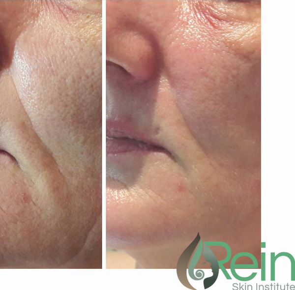 No-needle-skin-booster No-Needle-Skin-Booster
