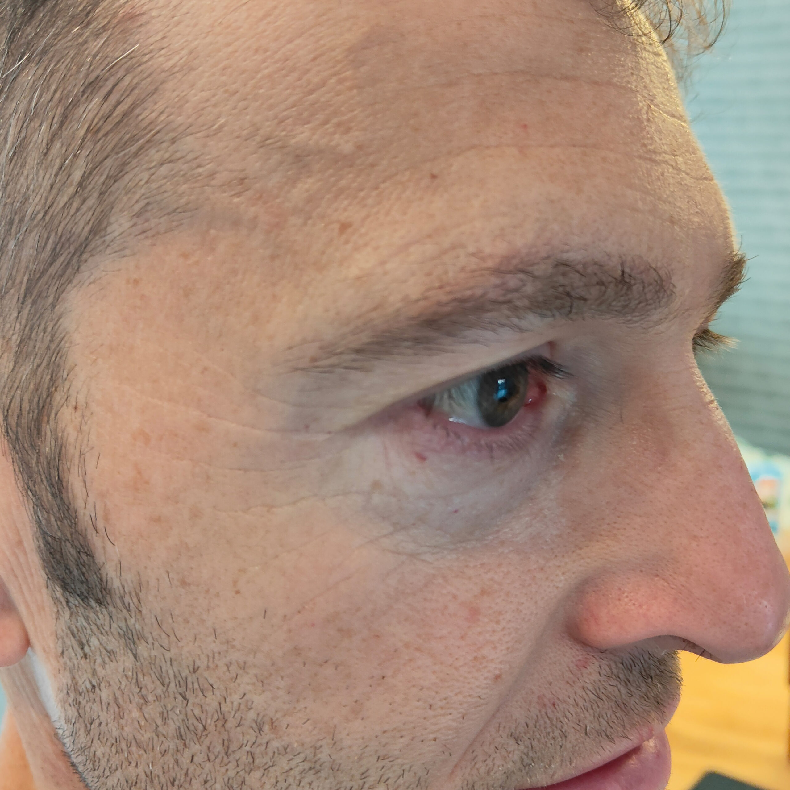 Voor en na foto's - Rein Skin Institute - Arnhem