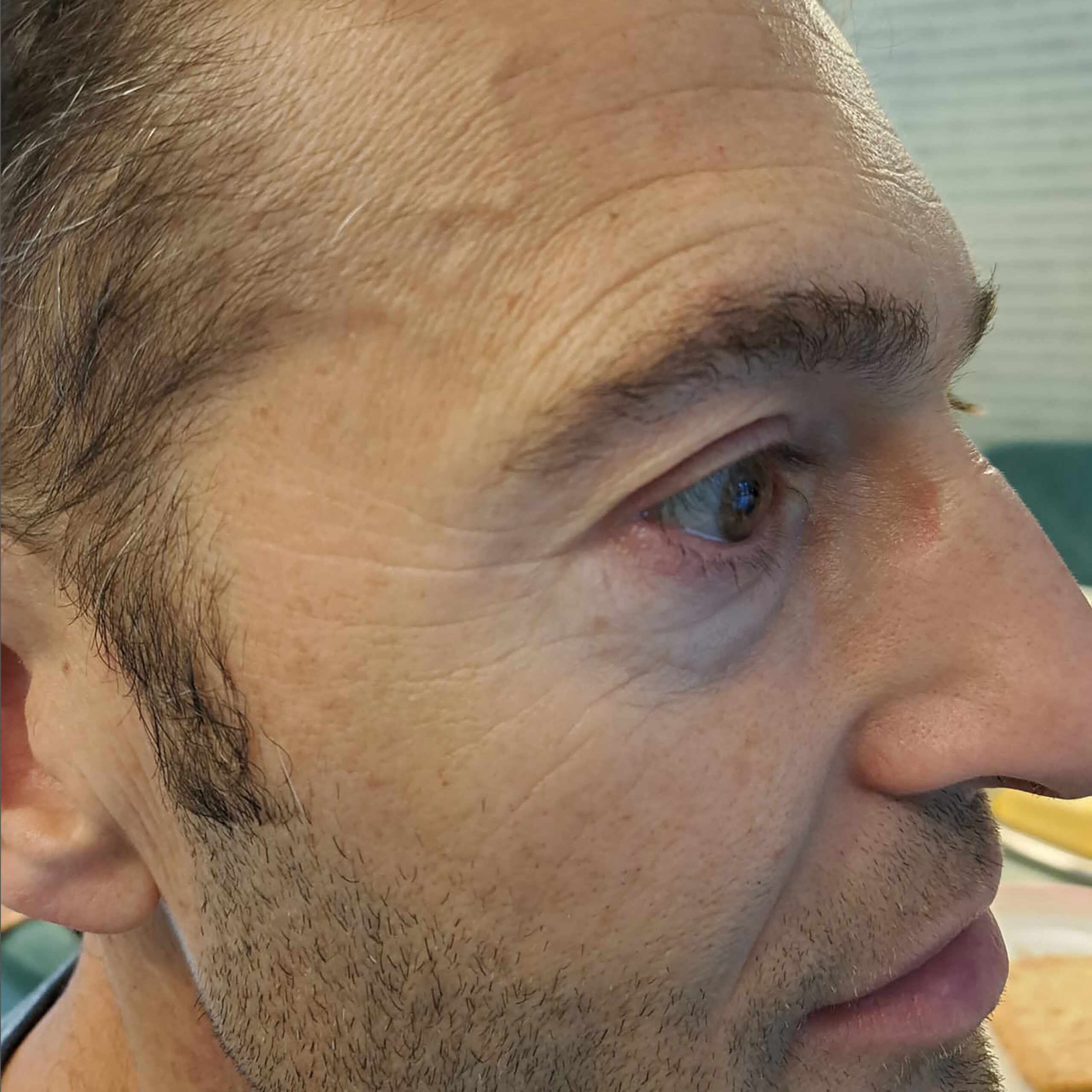 Voor en na foto's - Rein Skin Institute - Arnhem