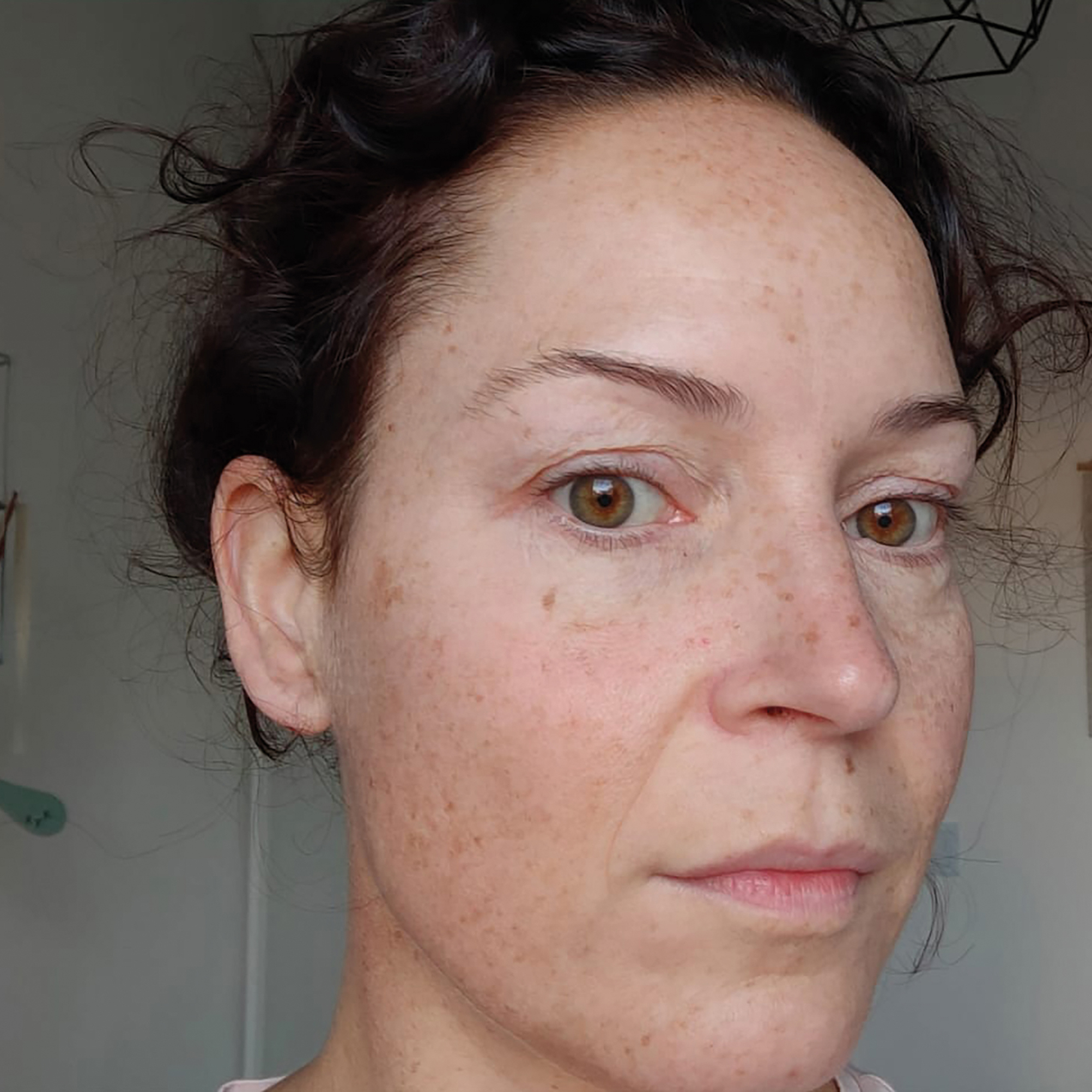 Voor en na foto's - Rein Skin Institute - Arnhem