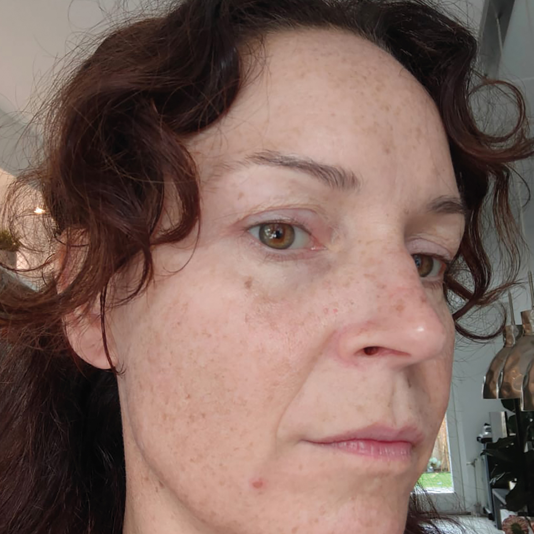 Voor en na foto's - Rein Skin Institute - Arnhem