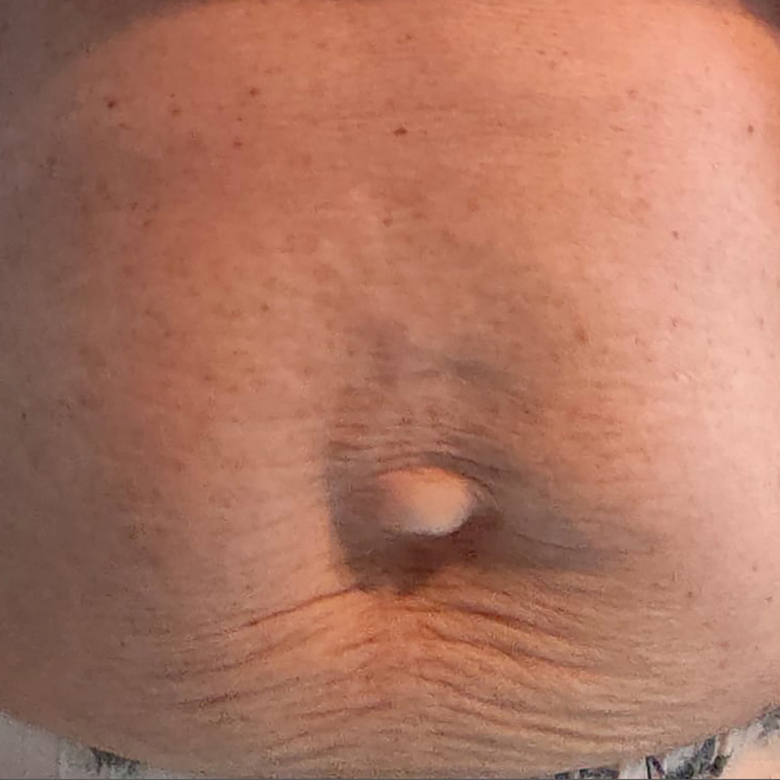 Voor en na foto's - Rein Skin Institute - Arnhem