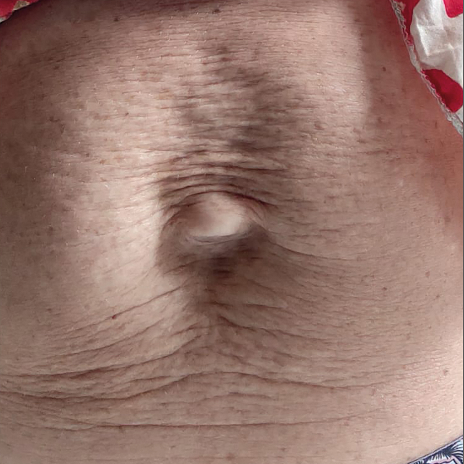 Voor en na foto's - Rein Skin Institute - Arnhem
